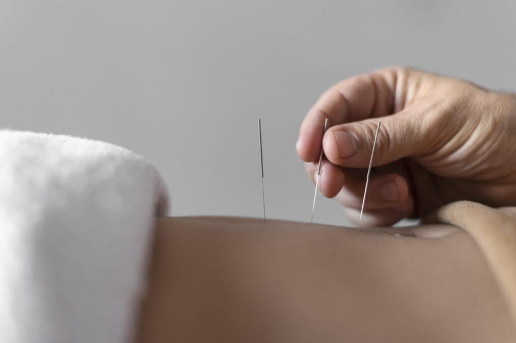Benefícios da acupuntura: Uma jornada para o bem-estar